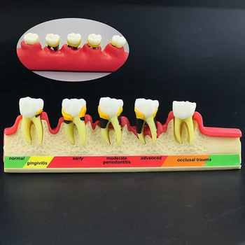 Zubné Periodontics Choroba 5-Fáze Zuby Sortim Demo Model Typodont M4010